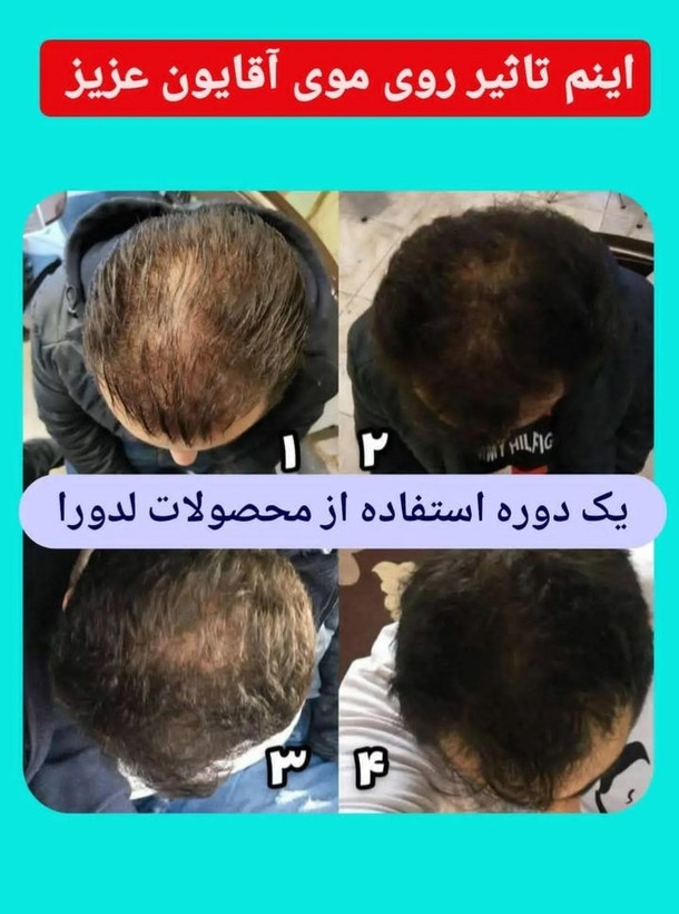 تونیک گیاهی تقویت کننده و ضدریزش موی سر لدورا هربال 40 میلی لیتر